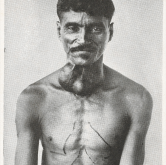 Man with Chagas disease (Wellcome Images)