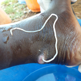 Guinea Worm (C. Bodimeade, Carter Centre)
